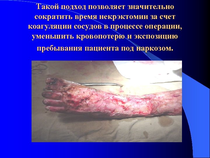 Такой подход позволяет значительно сократить время некрэктомии за счет коагуляции сосудов в процессе операции,