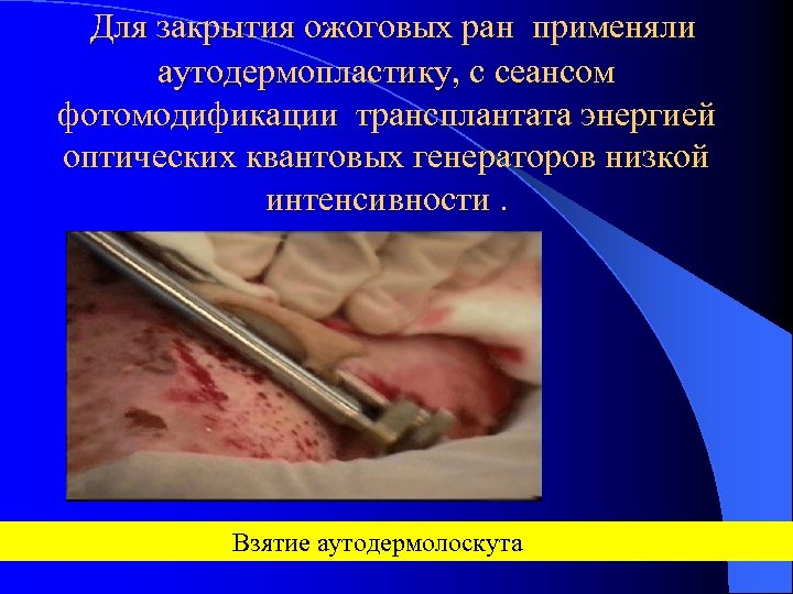 Для закрытия ожоговых ран применяли аутодермопластику, с сеансом фотомодификации трансплантата энергией оптических квантовых генераторов
