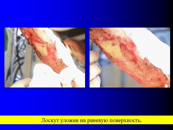 Лоскут уложен на раневую поверхность. 