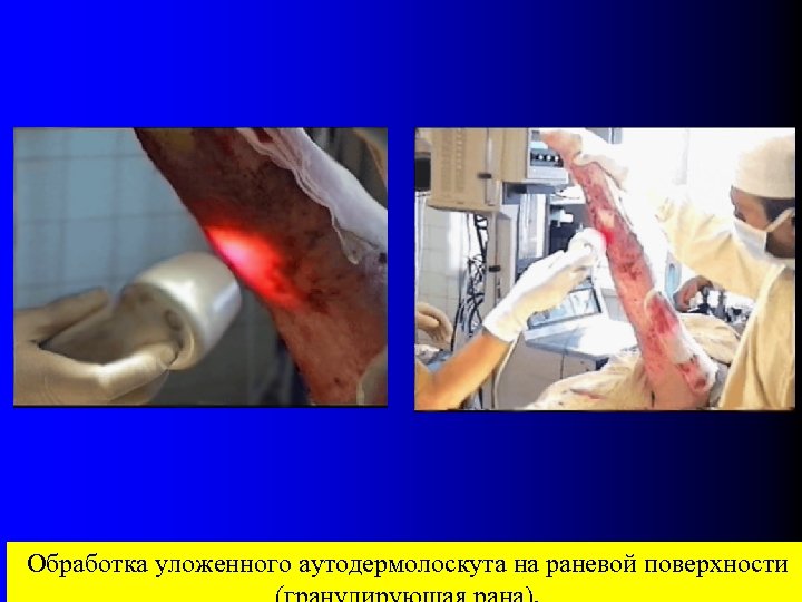 Обработка уложенного аутодермолоскута на раневой поверхности 