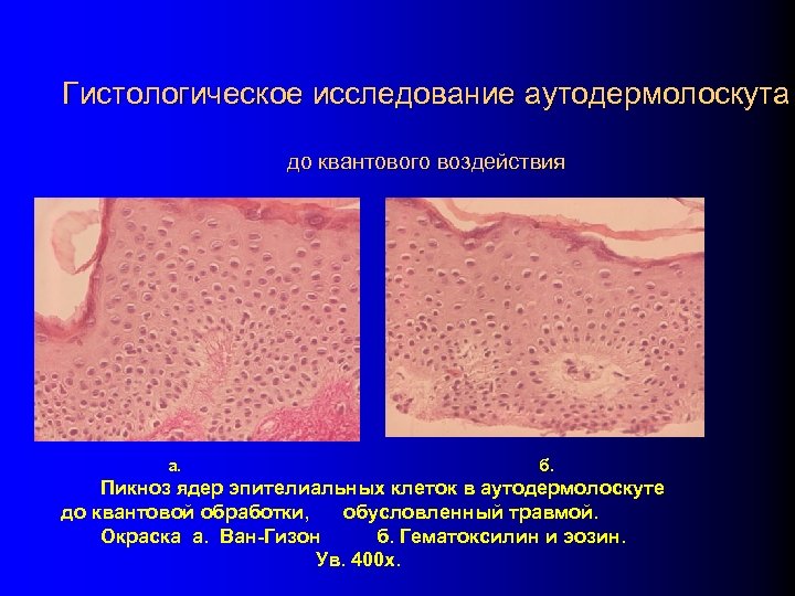 Гистологическое исследование аутодермолоскута до квантового воздействия а. б. Пикноз ядер эпителиальных клеток в аутодермолоскуте