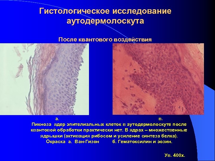 Гистологическое исследование аутодермолоскута После квантового воздействия а. в. Пикноза ядер эпителиальных клеток в аутодермолоскуте