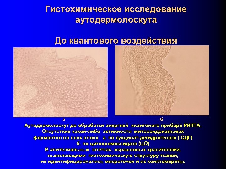 Гистохимическое исследование аутодермолоскута До квантового воздействия а б Аутодермолоскут до обработки энергией квантового прибора