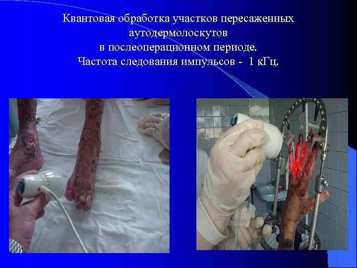 Квантовая обработка участков пересаженных аутодермолоскутов в послеоперационном периоде. Частота следования импульсов - 1 к.