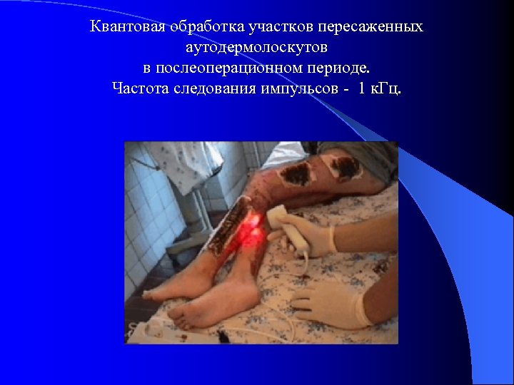 Квантовая обработка участков пересаженных аутодермолоскутов в послеоперационном периоде. Частота следования импульсов - 1 к.
