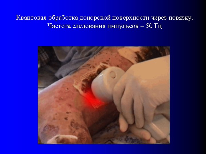 Квантовая обработка донорской поверхности через повязку. Частота следования импульсов – 50 Гц 