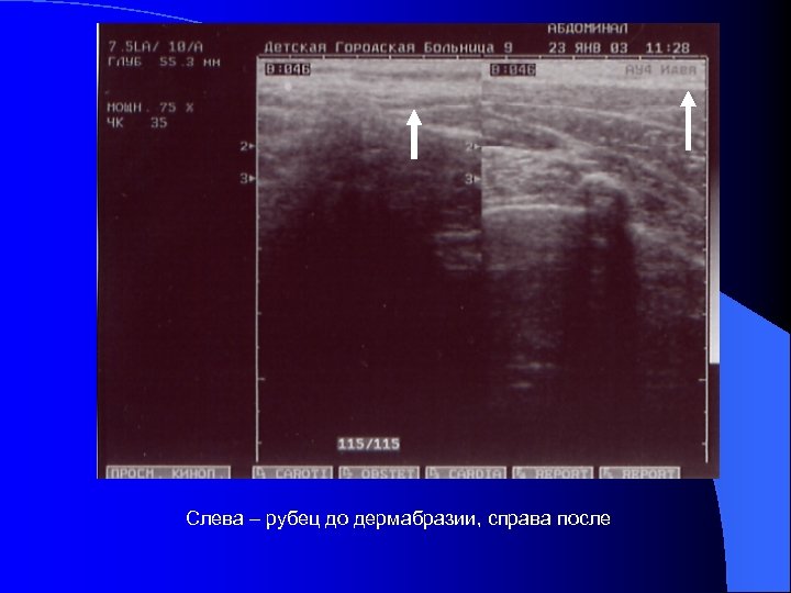Слева – рубец до дермабразии, справа после 