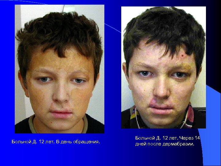 Больной Д. 12 лет. В день обращения. Больной Д. 12 лет. Через 14 дней