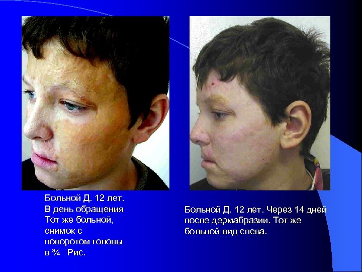 Больной Д. 12 лет. В день обращения Тот же больной, снимок с поворотом головы
