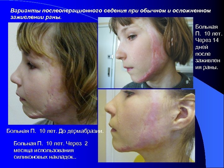 Варианты послеоперационного ведения при обычном и осложненном заживлении раны. Больная П. 10 лет. Через