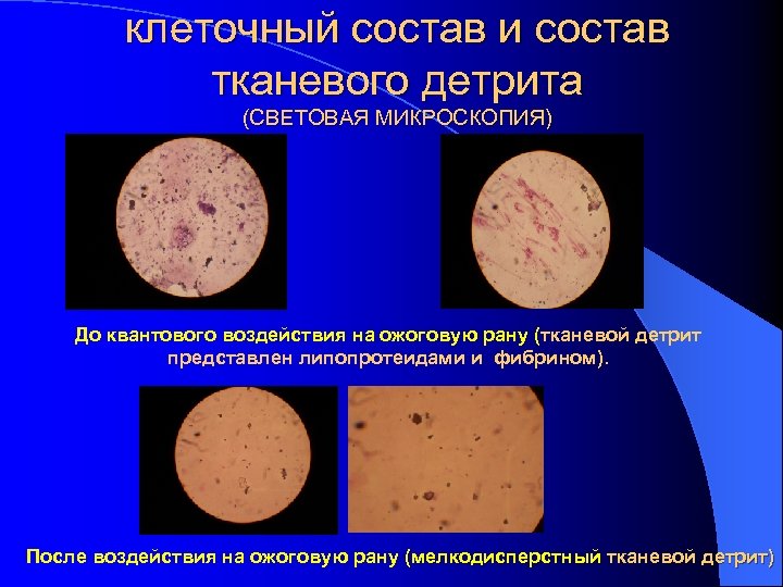 клеточный состав и состав тканевого детрита (СВЕТОВАЯ МИКРОСКОПИЯ) До квантового воздействия на ожоговую рану