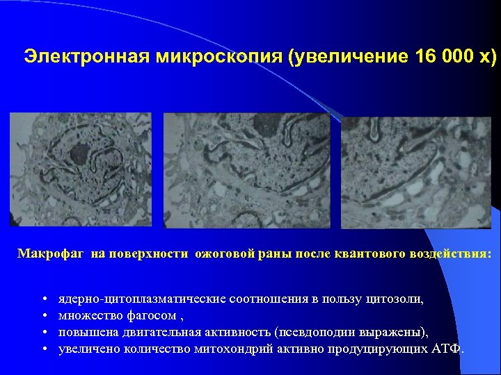 Электронная микроскопия (увеличение 16 000 х) Макрофаг на поверхности ожоговой раны после квантового воздействия: