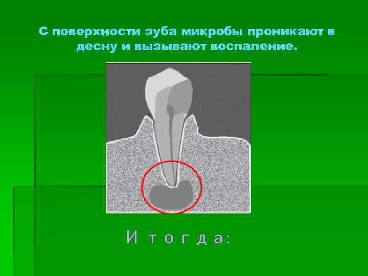 С поверхности зуба микробы проникают в десну и вызывают воспаление. И тогда: 