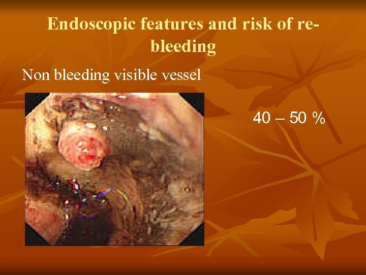 Endoscopic features and risk of rebleeding Non bleeding visible vessel 40 – 50 %