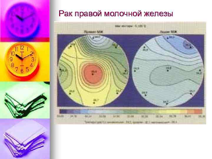 Рак правой молочной железы 