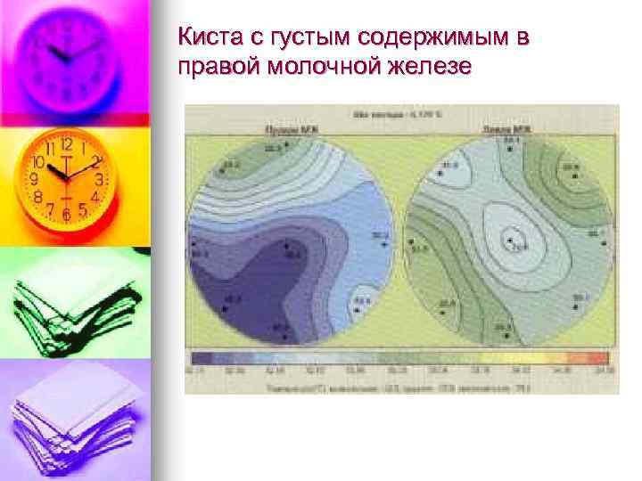 Киста с густым содержимым в правой молочной железе 