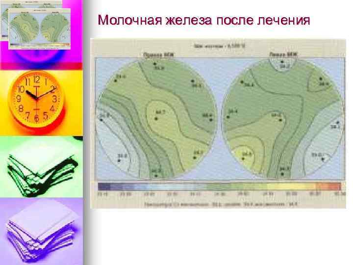 Молочная железа после лечения 