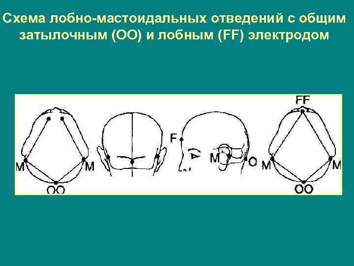 Схема лобно-мастоидальных отведений с общим затылочным (ОО) и лобным (FF) электродом 