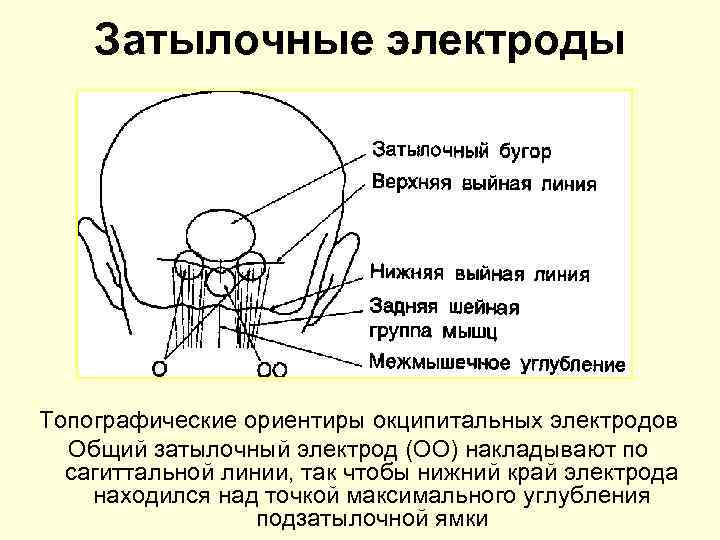 Затылочные электроды Топографические ориентиры окципитальных электродов Общий затылочный электрод (ОО) накладывают по сагиттальной линии,