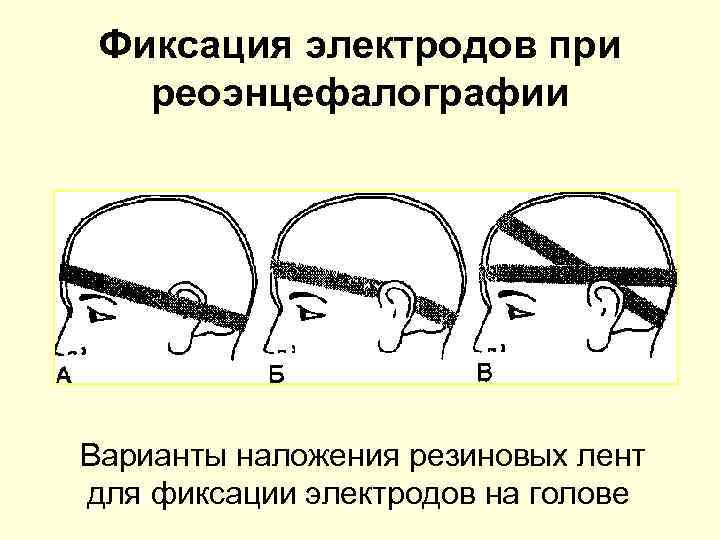 Фиксация электродов при реоэнцефалографии Варианты наложения резиновых лент для фиксации электродов на голове 