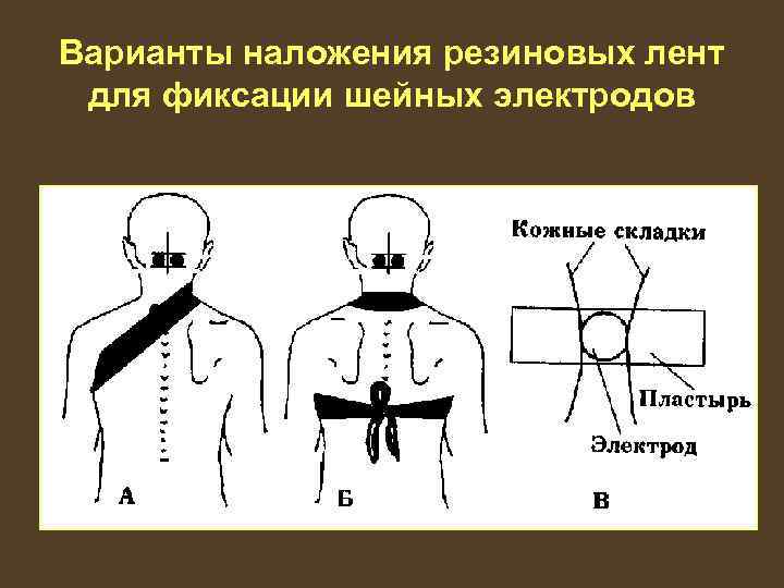 Варианты наложения резиновых лент для фиксации шейных электродов 