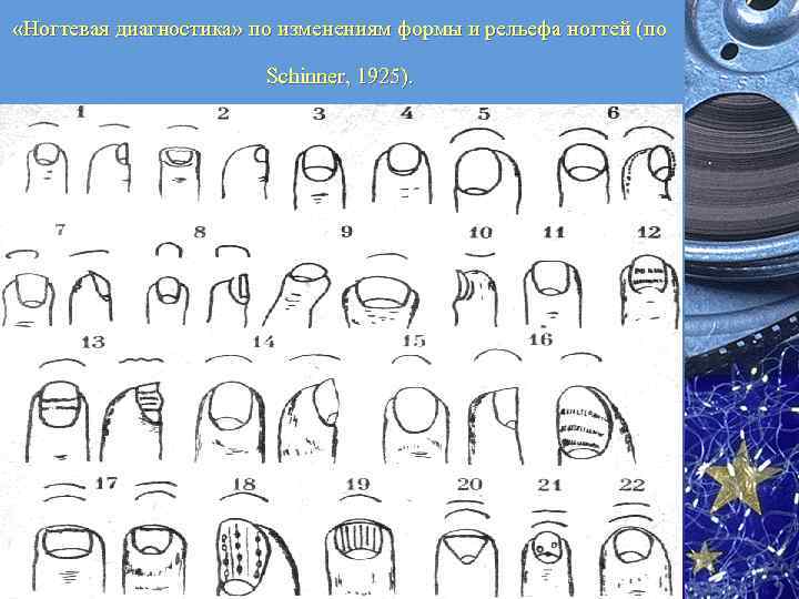  «Ногтевая диагностика» по изменениям формы и рельефа ногтей (по Schinner, 1925). 