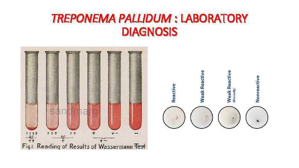 TREPONEMA PALLIDUM : LABORATORY DIAGNOSIS 