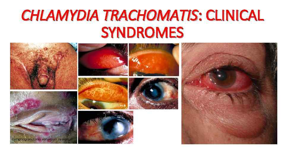 CHLAMYDIA TRACHOMATIS: CLINICAL SYNDROMES 