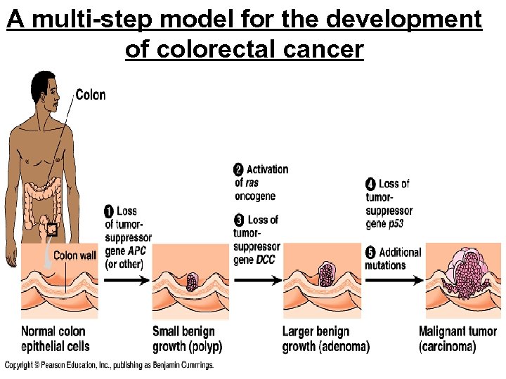 A multi-step model for the development of colorectal cancer 