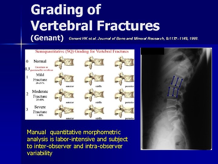 Grading of Vertebral Fractures (Genant) Genant HK et al. Journal of Bone and Mineral