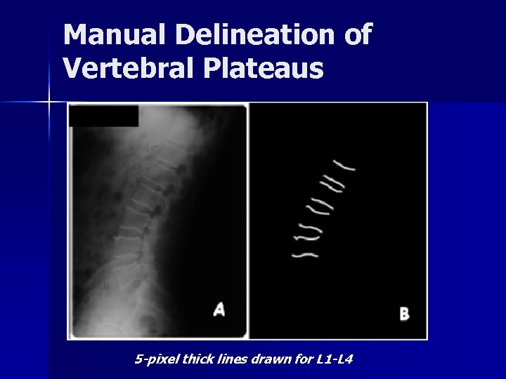 Manual Delineation of Vertebral Plateaus 5 -pixel thick lines drawn for L 1 -L