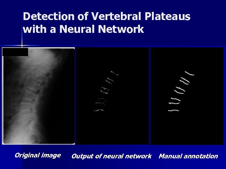 Detection of Vertebral Plateaus with a Neural Network Original image Output of neural network