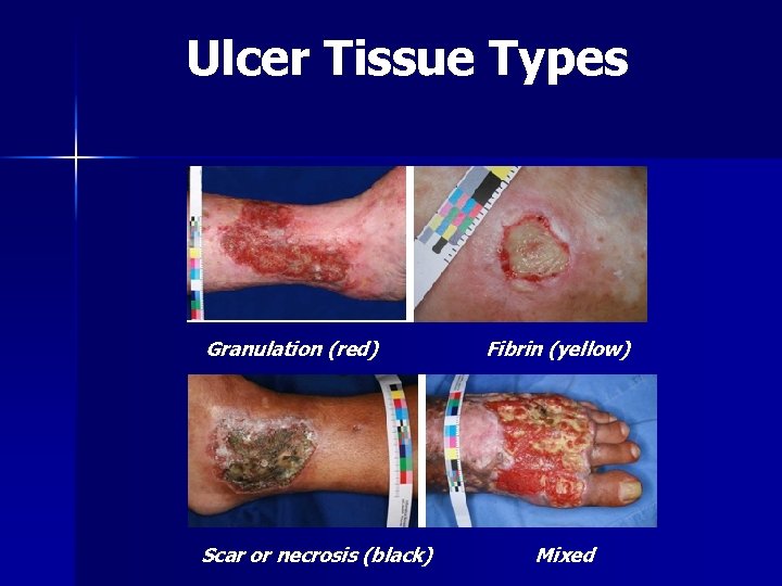 Ulcer Tissue Types Granulation (red) Scar or necrosis (black) Fibrin (yellow) Mixed 