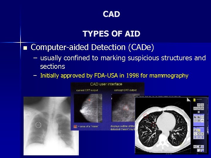 CAD TYPES OF AID n Computer-aided Detection (CADe) – usually confined to marking suspicious