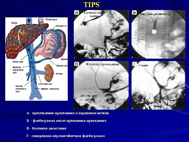 TIPS А - прохождение проводника в паренхиме печени Б - флебограмма после проведения проводника