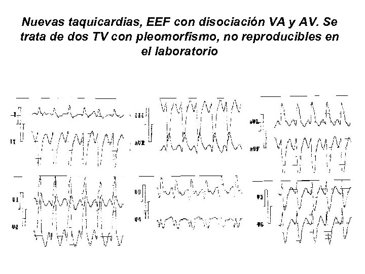 Nuevas taquicardias, EEF con disociación VA y AV. Se trata de dos TV con