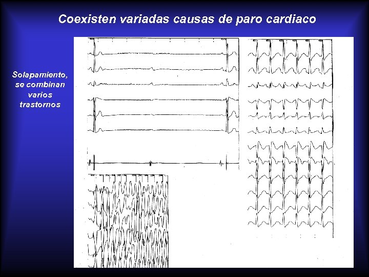 Coexisten variadas causas de paro cardiaco Solapamiento, se combinan varios trastornos 