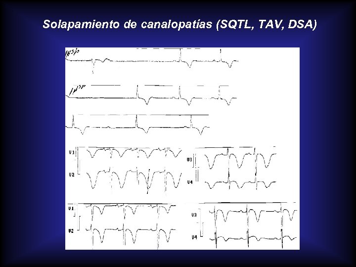 Solapamiento de canalopatías (SQTL, TAV, DSA) 