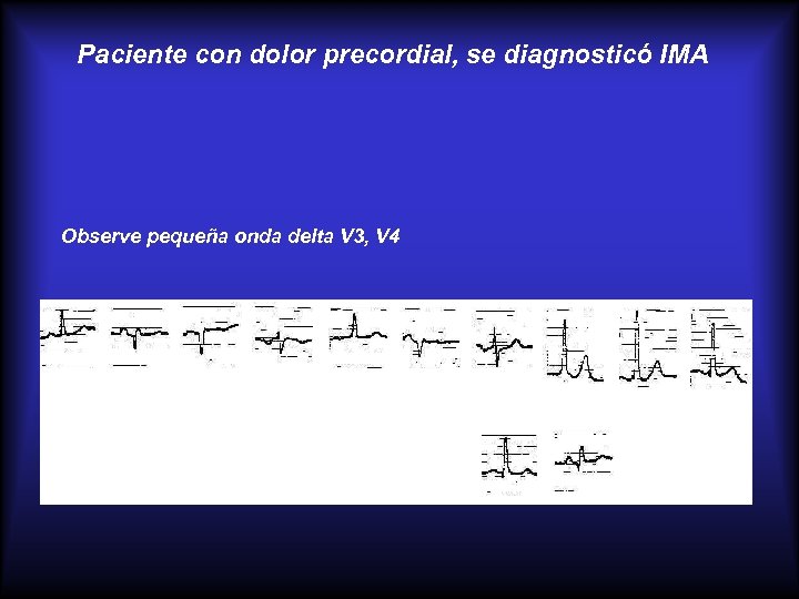 Paciente con dolor precordial, se diagnosticó IMA Observe pequeña onda delta V 3, V