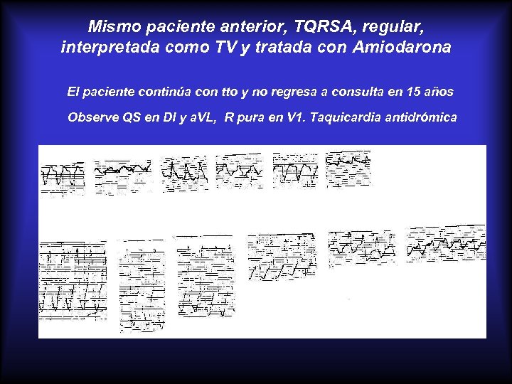 Mismo paciente anterior, TQRSA, regular, interpretada como TV y tratada con Amiodarona El paciente