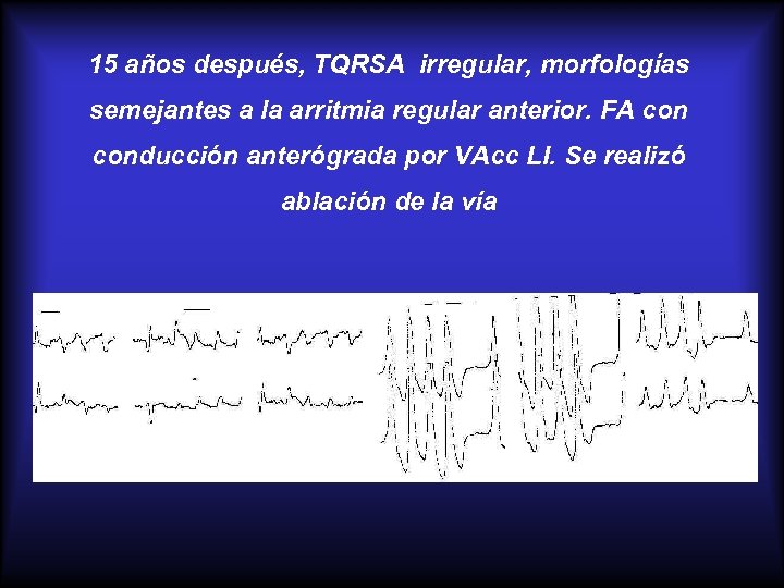 15 años después, TQRSA irregular, morfologías semejantes a la arritmia regular anterior. FA conducción