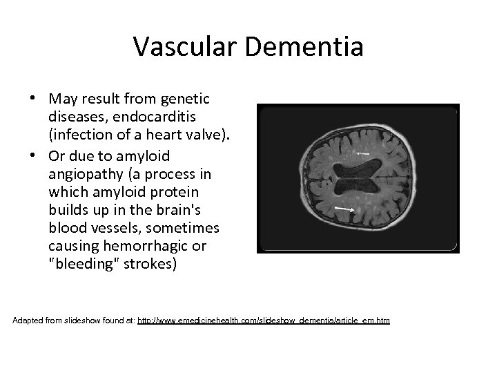 Vascular Dementia • May result from genetic diseases, endocarditis (infection of a heart valve).