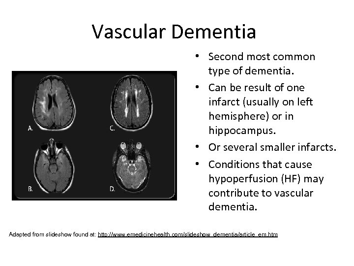 Vascular Dementia • Second most common type of dementia. • Can be result of
