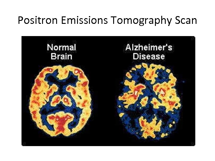 Positron Emissions Tomography Scan 
