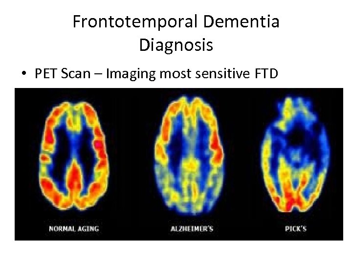 Frontotemporal Dementia Diagnosis • PET Scan – Imaging most sensitive FTD 