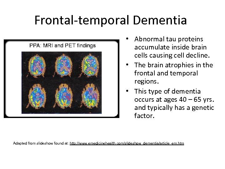 Frontal-temporal Dementia • Abnormal tau proteins accumulate inside brain cells causing cell decline. •