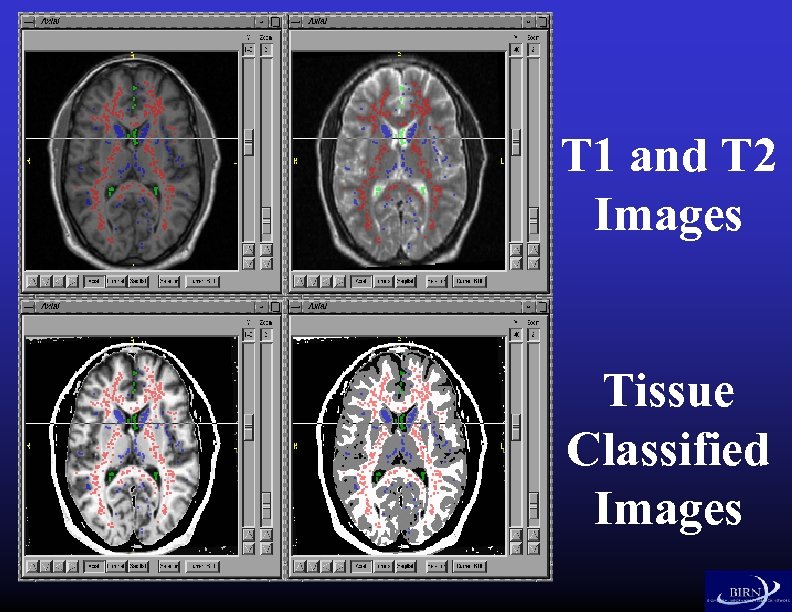 T 1 and T 2 Images Tissue Classified Images 