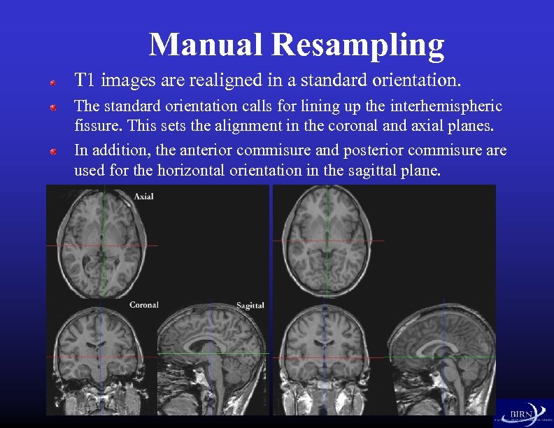 Manual Resampling T 1 images are realigned in a standard orientation. The standard orientation