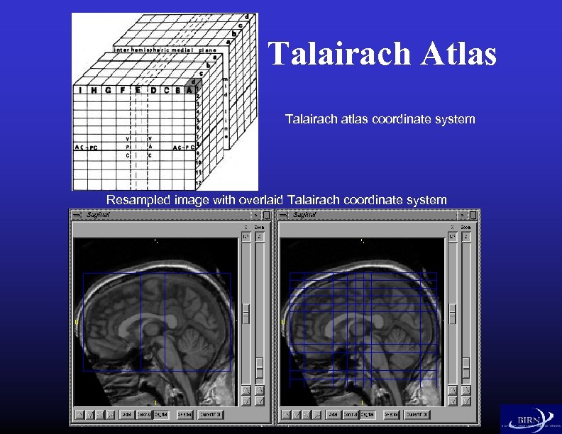 Talairach Atlas Talairach atlas coordinate system Resampled image with overlaid Talairach coordinate system 