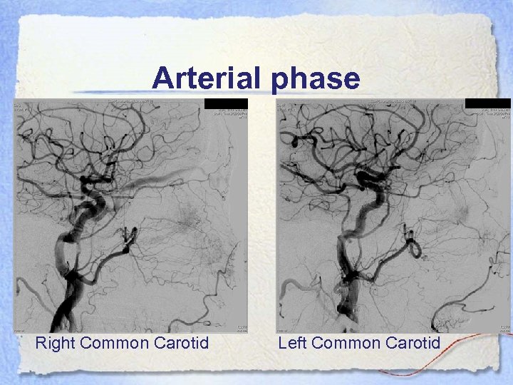 Arterial phase Right Common Carotid Left Common Carotid 